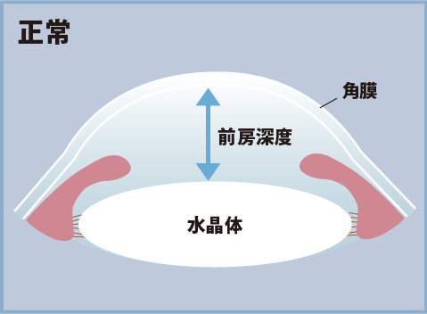 目の前房深度のイメージ（正常）