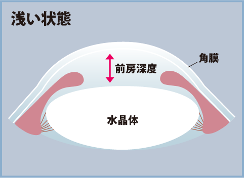 目の前房深度のイメージ（浅い状態）