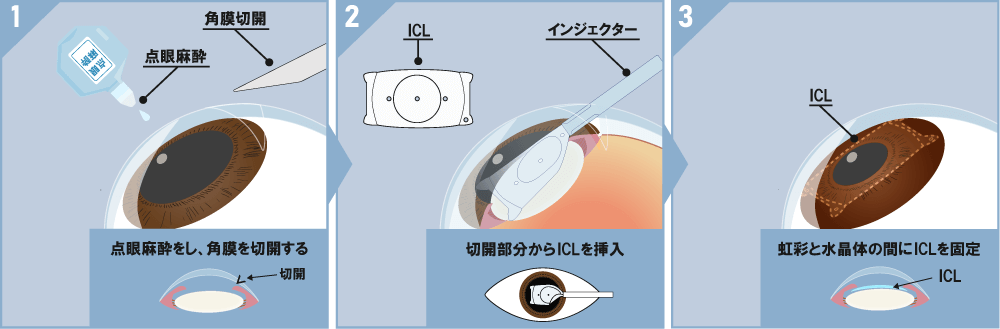 ICL治療の流れ