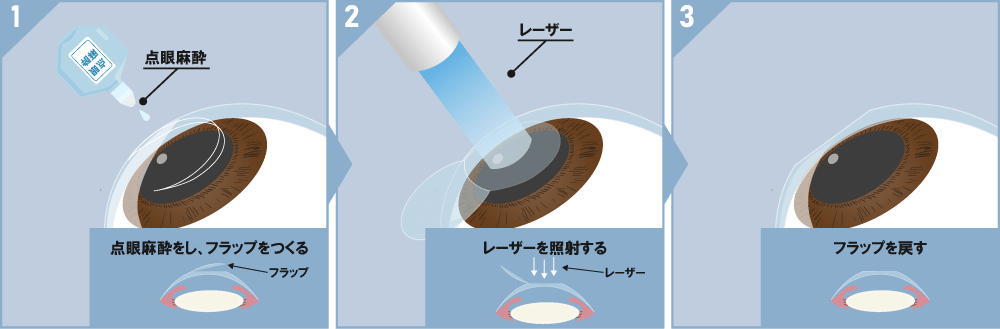 レーシック治療の流れ