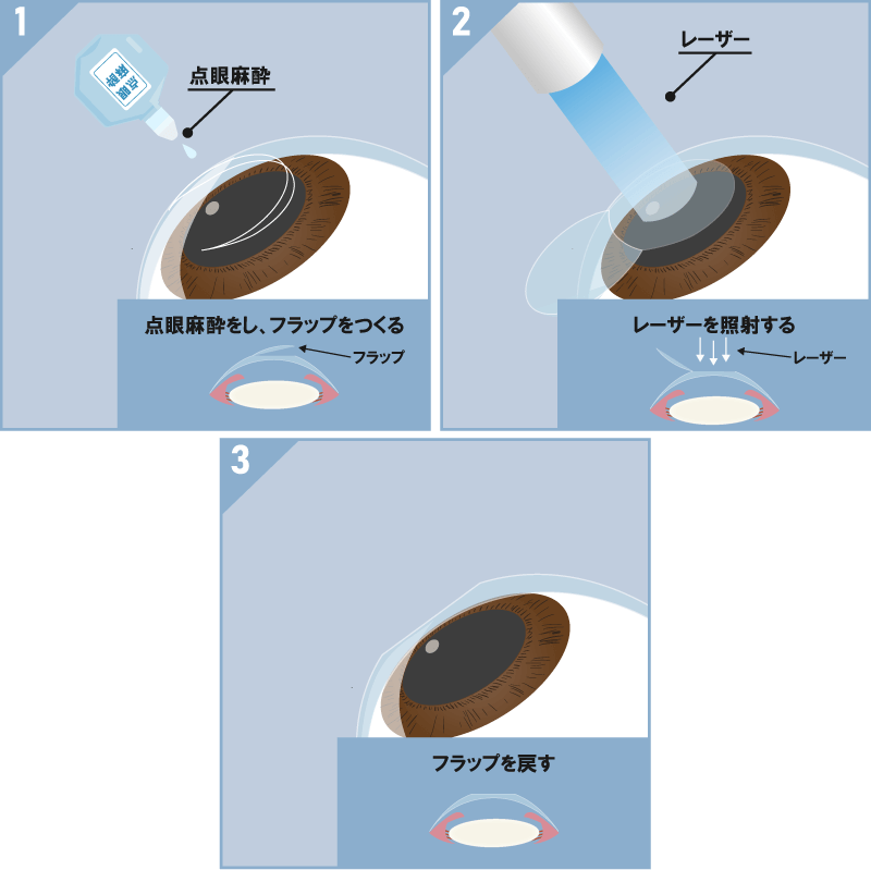 レーシック治療の流れ